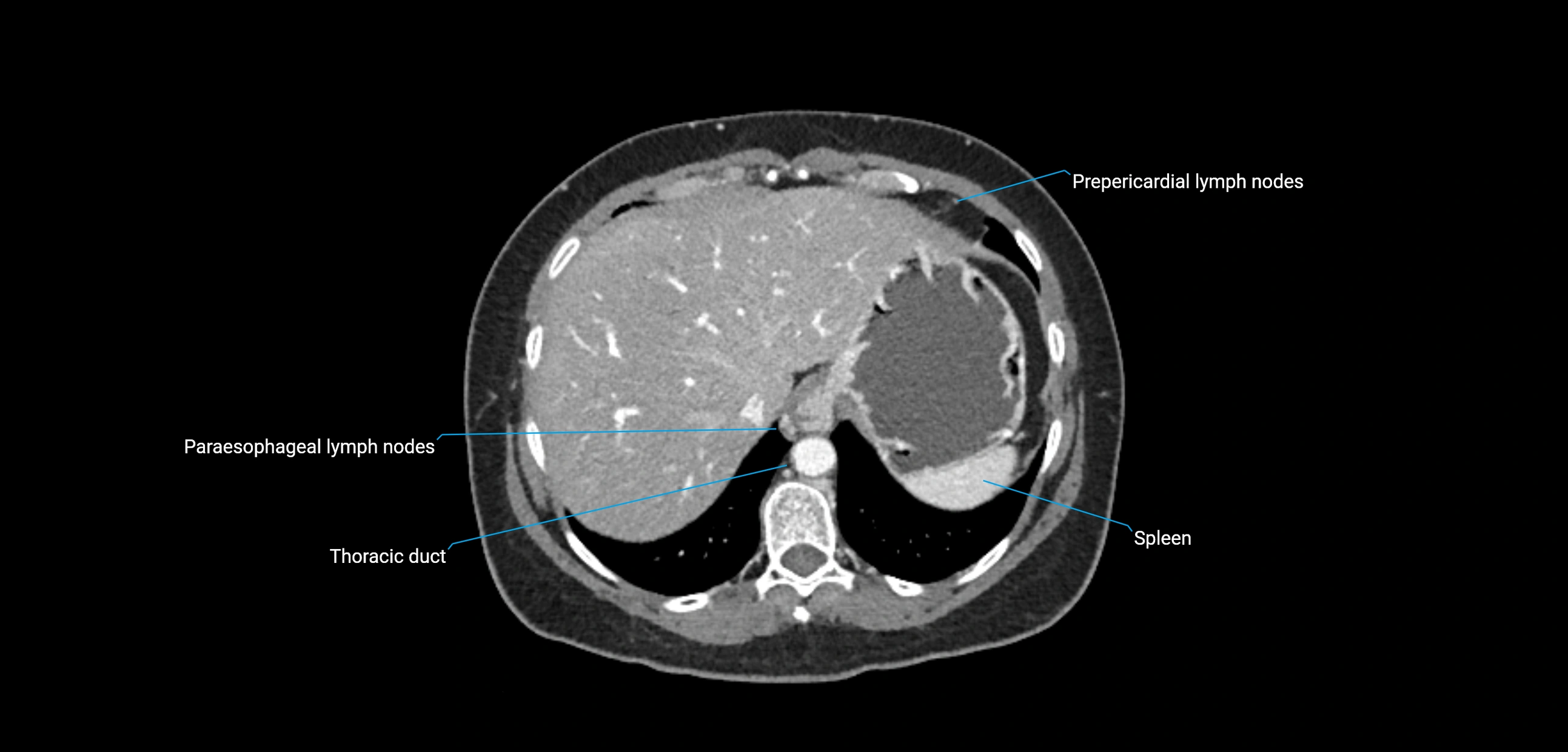 CT ct abdominal lymph nodes  axial cross sectional anatomy  enchanced radiology image -img-00002-00087.webp